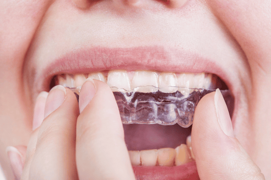 Unveiling the Secret to a Perfect Smile: The Magic of Clear Aligners